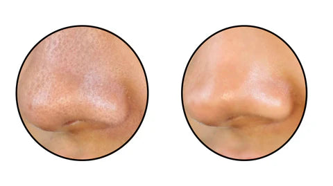 Limpiador de Poros Facial mediante Succión