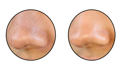 Limpiador de Poros Facial mediante Succión